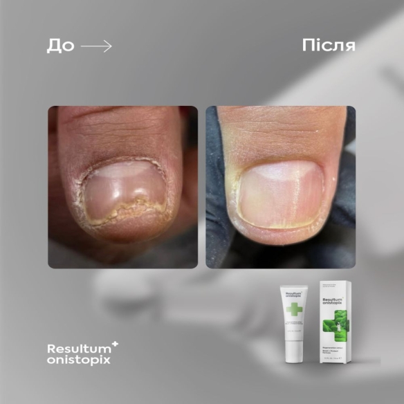 Resultum Onistopix Lotion – Onycholysis Lotion, 10 ml