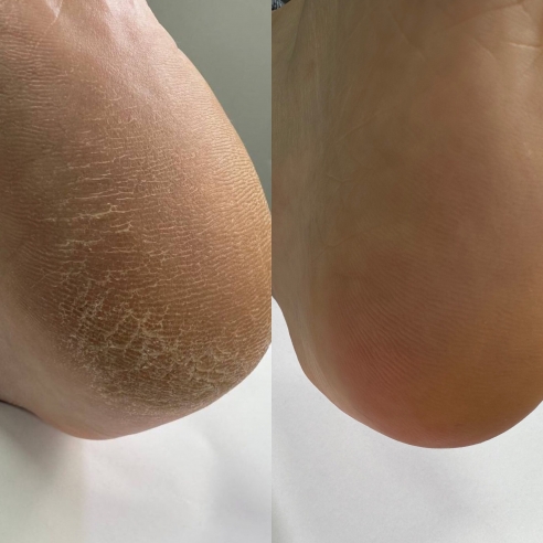 Nailsoftheday Podology+ KERATOLITIC for feet,...