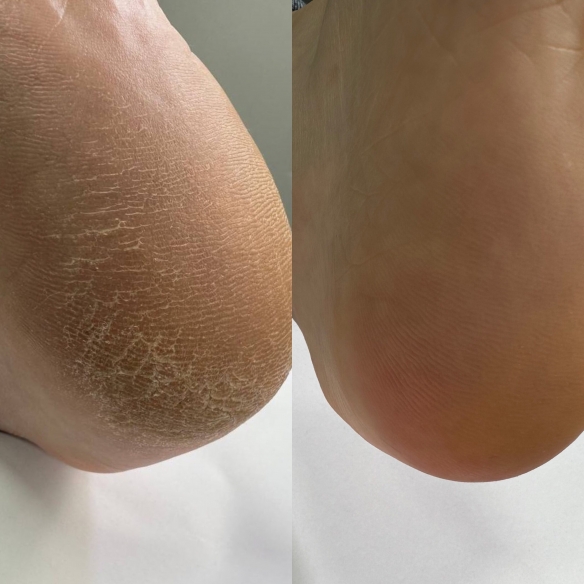 Nailsoftheday Podology+ KERATOLITIC for feet, 100 ml