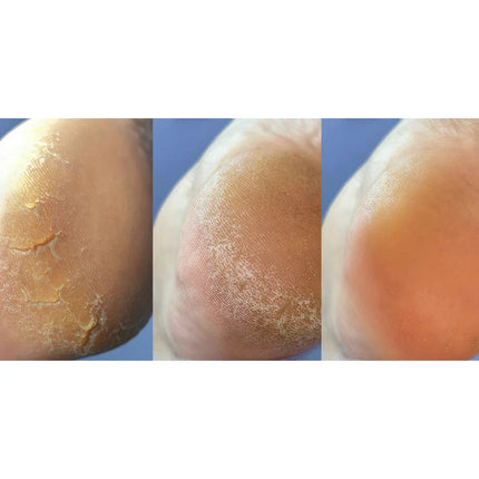 Nailsoftheday Podology+ CREAM against cracks, developed for healing cracks on the skin of hands and feet, 30 ml