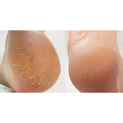 Nailsoftheday Podology+ CREAM against cracks, developed for healing cracks on the skin of hands and feet, 30 ml