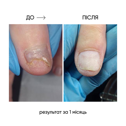 NAILSOFTHEDAY ONISTOP – regenerating oil against onycholysis, 8 ml