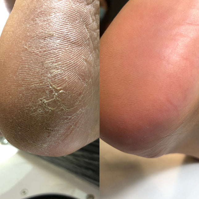 Nailsoftheday Podology+ KERATOLITIC for feet, 100 ml