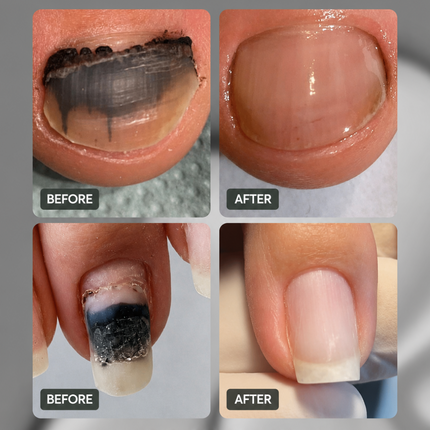 Resultum Onistopix Oil- for onycholysis and fungus