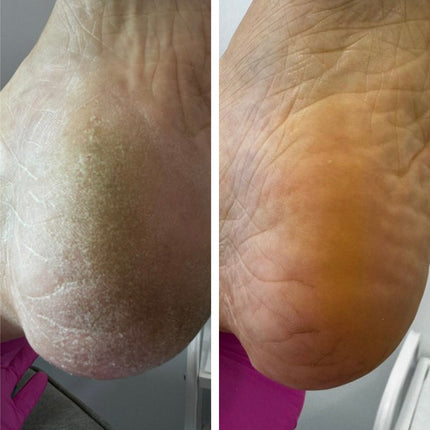 Resultum Regenerix – Anti Crack Cream Jojoba – jojoba cream for cracked hands and feet