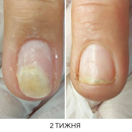 NAILSOFTHEDAY ONISTOP – regenerating oil against onycholysis, 8 ml